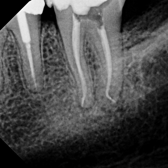 After Endodontic Treatment Case 5 - Harp Endodontics Manhattan New York
